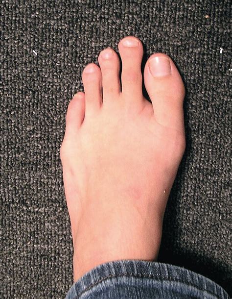 Are people with Morton's toe more athletic?