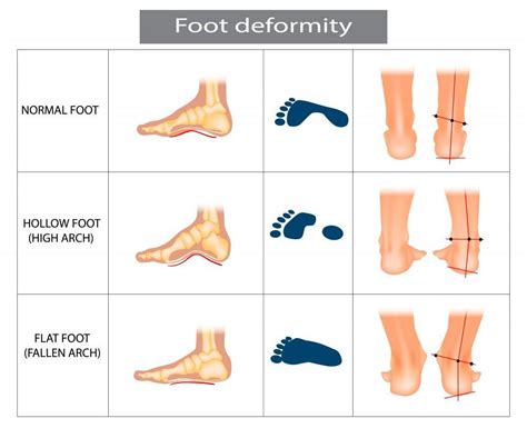 Are people with flat feet rare?