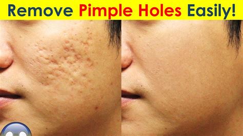 Are pimple holes permanent?