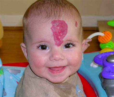 Are pink birthmarks rare?