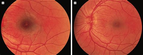 Are retinal burns permanent?