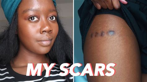 Are scars lighter on dark skin?