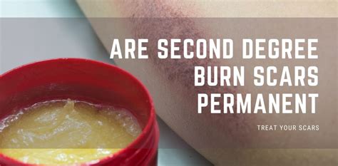 Are second-degree burn scars permanent?