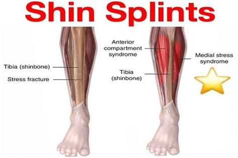 Are shin splints soft or hard tissue?