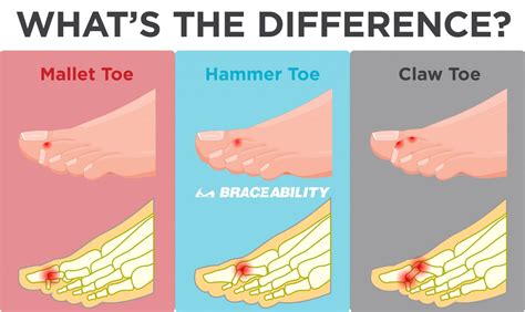 Are slightly bent toes normal?