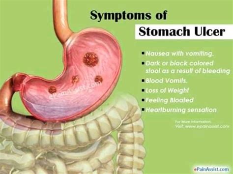 Are stomach ulcers obvious?