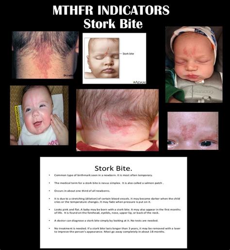 Are stork bites signs of Mthfr in babies?