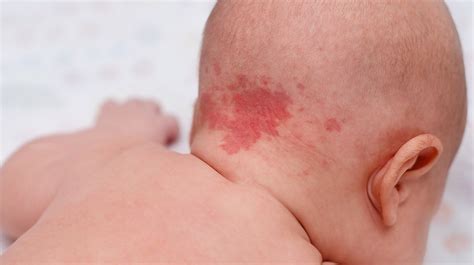 Are strawberry birthmarks permanent?