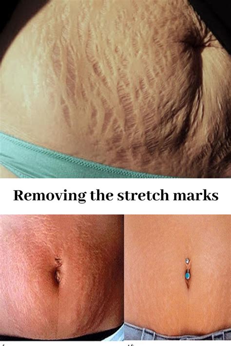 Are stretch marks attractive?
