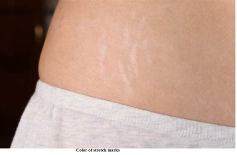 Are stretch marks genetic?