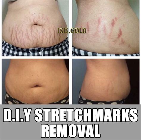 Are stretch marks permanent?