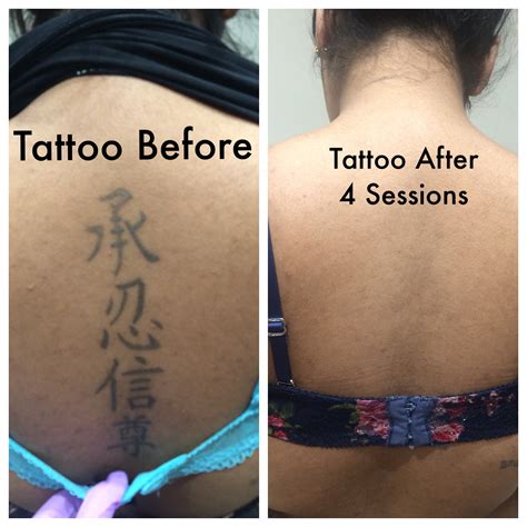 Are tattoo removal worth it?