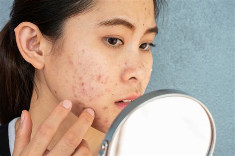 Are there any benefits to having acne?