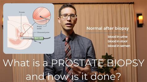 Are there different types of prostate biopsies?