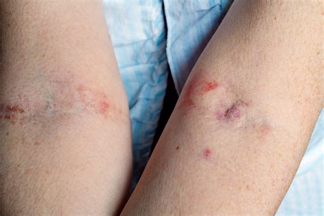 Are there skin signs of leukemia?