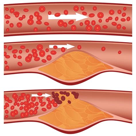 Are there warning signs of clogged arteries?