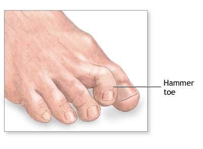 Are toes hereditary?