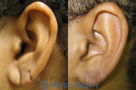 Are torn earlobes common?