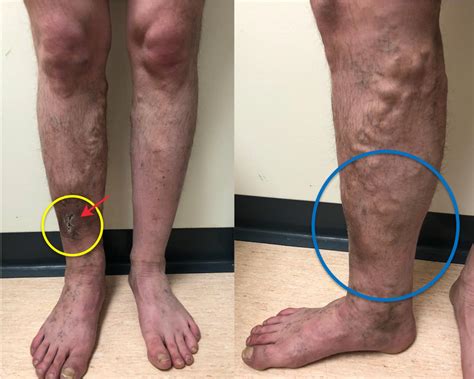 Are veins under fat?