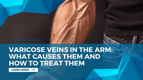 Are veiny arms risky?