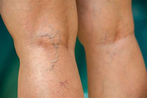 Are visible blue veins healthy?