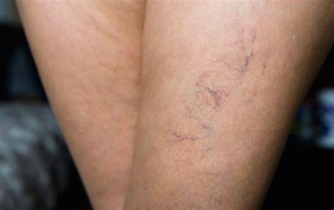 Are visible veins attractive?