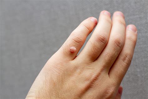 Are warts on fingers an STD?