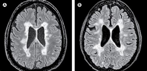 Are white matter lesions always MS?