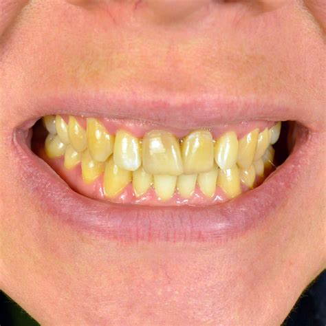 Are yellow teeth permanent?