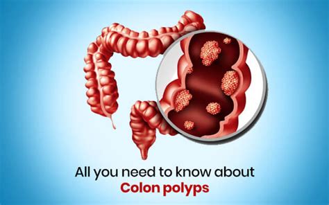 Are you born with colon polyps?