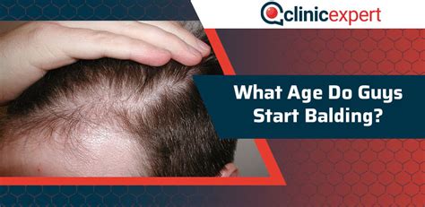 At what age baldness starts?