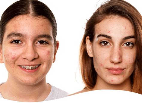 At what age does acne normally go away?