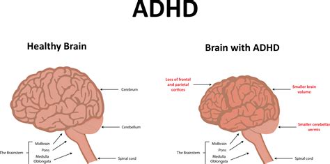 At what age does an ADHD brain fully develop?