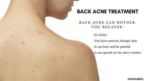 At what age does back acne disappear?