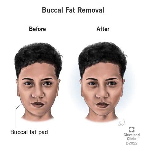 At what age does face fat go away?