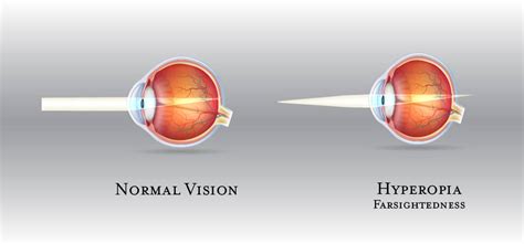 At what age does farsightedness stop?