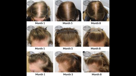 At what age does hair stop growing on your head?