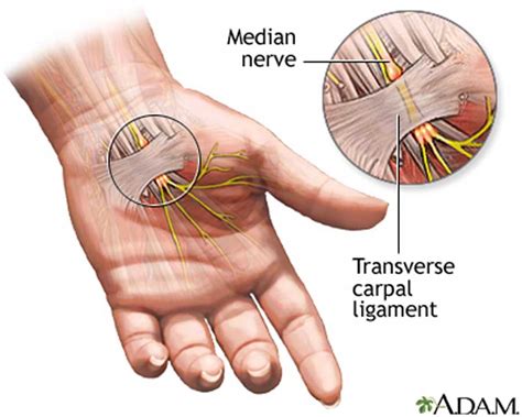 At what age is carpal tunnel normal?