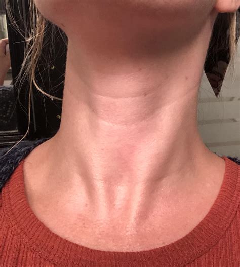 At what age neck lines appear?