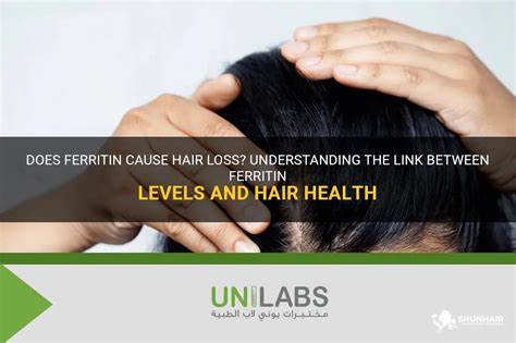 At what ferritin level does hair fall out?