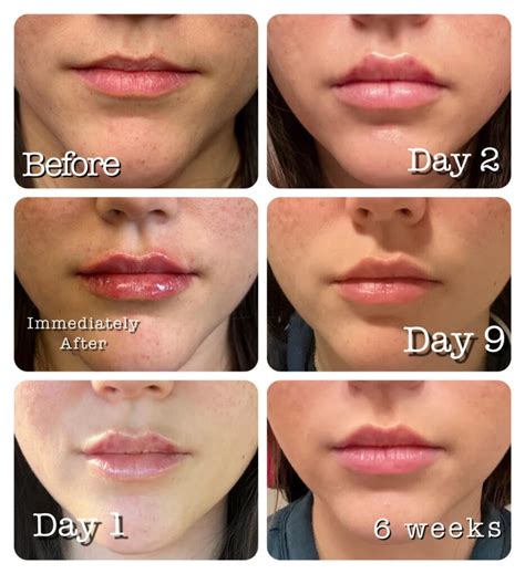 Can 0.5 mL of lip filler migrate?