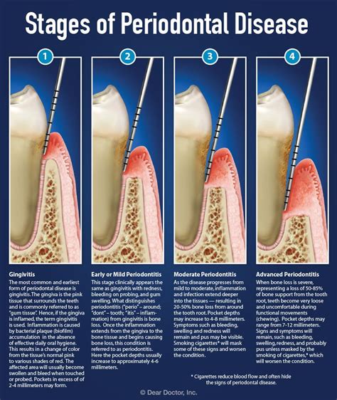 Can 10mm gum pockets be reversed?