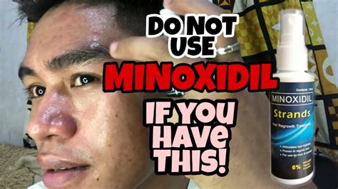 Can 17 year old use minoxidil?