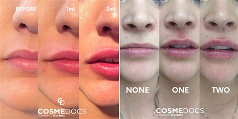 Can 1ml lip filler look natural?