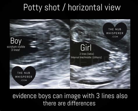 Can 3 lines on ultrasound mean boy?