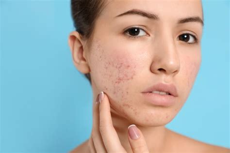 Can Accutane affect facial hair?