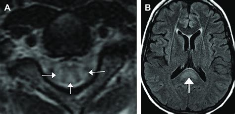 Can B12 deficiency look like MS on MRI?