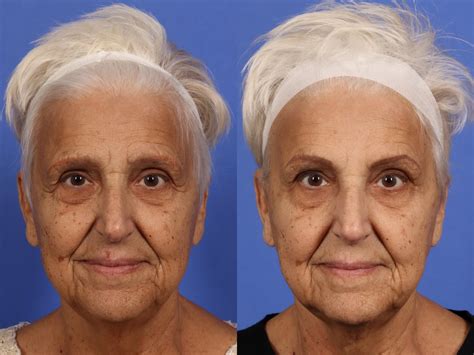 Can Botox age your face?