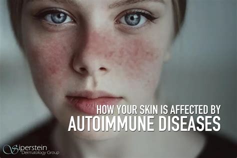 Can Botox cause autoimmune?