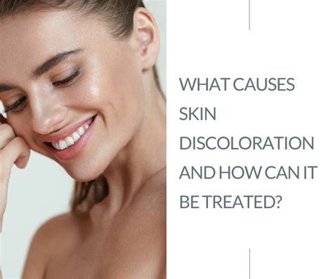 Can Botox cause discoloration?
